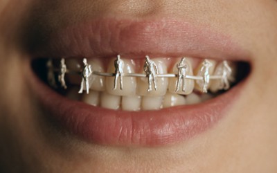 braces colors teeth dental brace tooth cool weird jewelry cost gem orthodontic instagram face quick